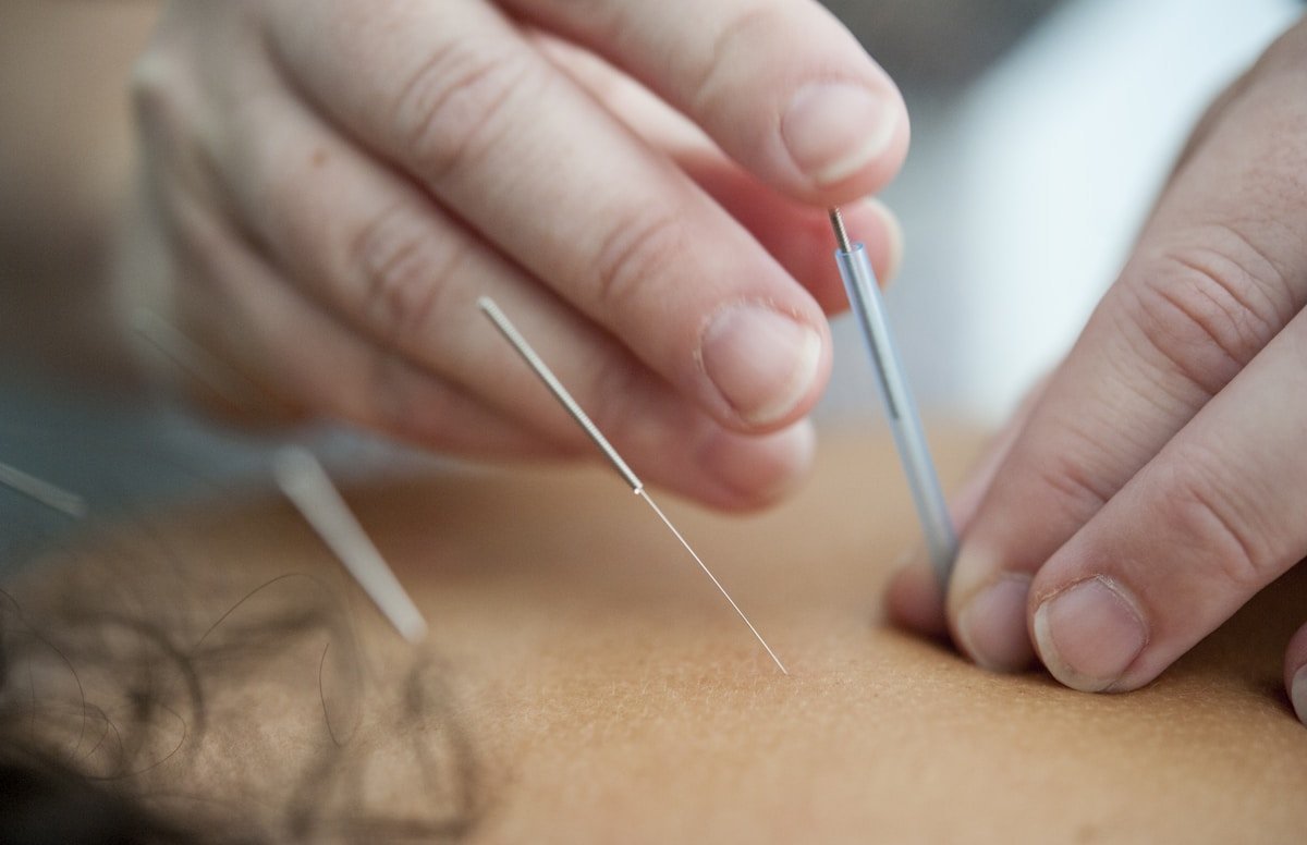 Acupuncture for Back Pain: Does It Really Work? A UK Guide
